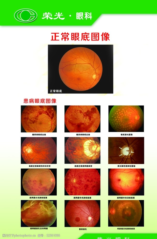 视网膜病变常见眼底病变