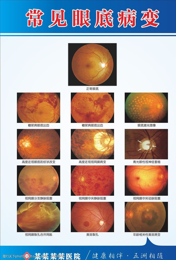 视网膜病变眼底病变